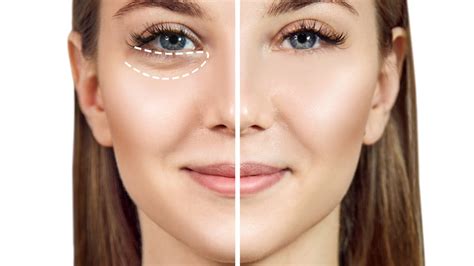 how to remove bags from under eyes